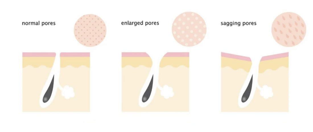 How to get rid of large pores - 6 products that will help